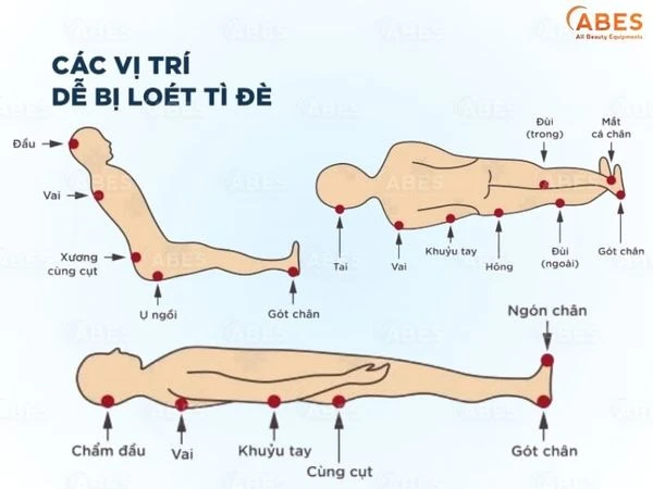 cac-vi-tri-de-bi-loet-ty-de_8c2ddb2a55e749c48861236a5f757777_grande